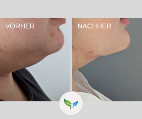 Fettabsaugung Vorher und Nachher Bilder 16 Fettabsaugung Doppelkinn – Vorher-Nachher Aufnahme