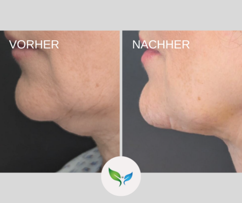 Fettabsaugung Vorher und Nachher Bilder 14 Fettabsaugung am Doppelkinn – natürliches Vorher-Nachher Ergebnis