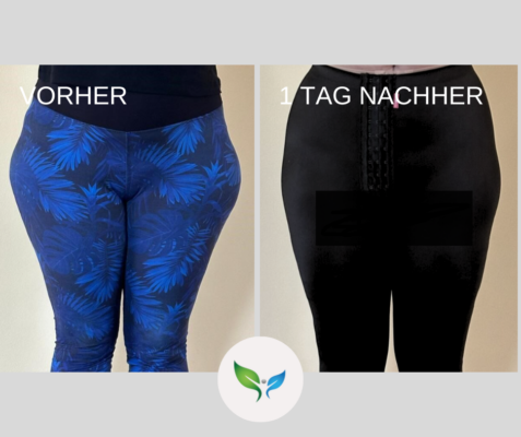 Fettabsaugung an den Oberschenkeln – sanftes Vorher-Nachher Ergebnis
