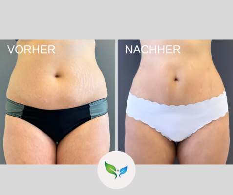 Mini-Bauchdeckenstraffung mit Liposuktion – natürliches Vorher-Nachher Ergebnis