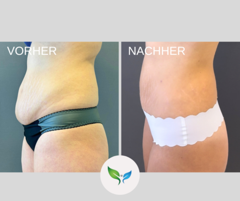 Mini-Bauchdeckenstraffung und Liposuktion – deutliche Körperveränderung Vorher-Nachher