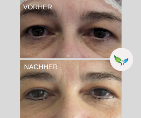 Lidstraffung vorher und nachher bilder 46 Blepharoplastik vorher und nachher – Ergebnis der Oberlidkorrektur