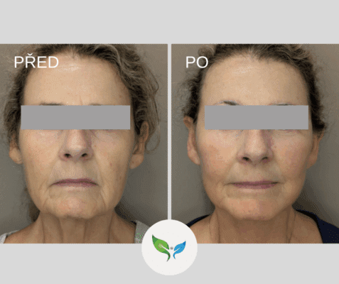 Deep plane facelift - operoval MUDr. Bayer