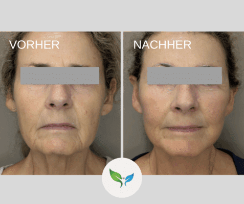 Deep plane facelift Dr. Bayer