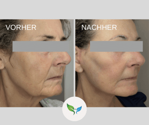 Deep plane facelift Dr. Bayer - Profilfoto