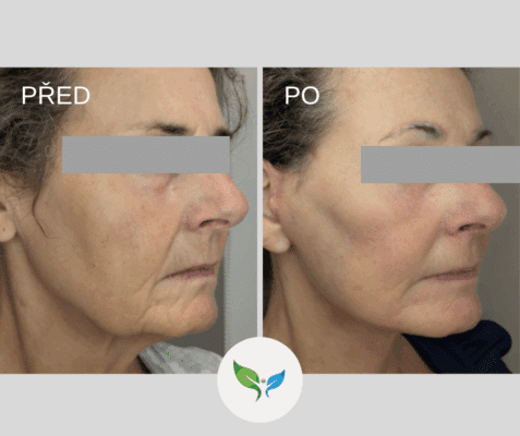 Deep plane facelift - foto z profilu - MUDr. Bayer