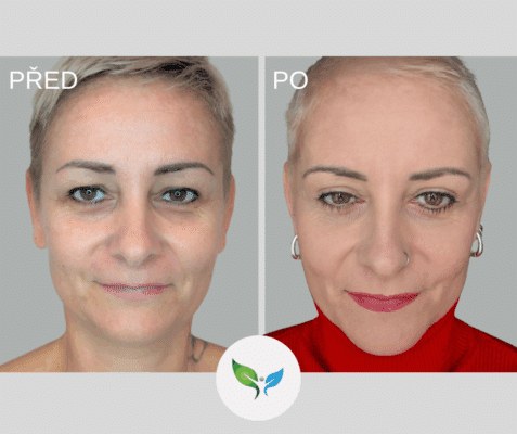 Plastika víček - Blefaroplastika - celý obličej