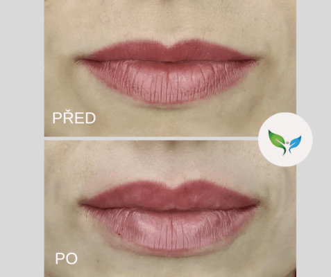 Zvětšení rtů kyselinou hyaluronovou před a po