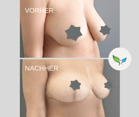 Bruststraffung - vorher und nachher