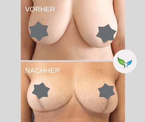Bruststraffung - vorher und nachher
