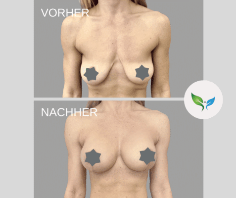 Brustvergrößerung (Augmentation) - vorher und nachher