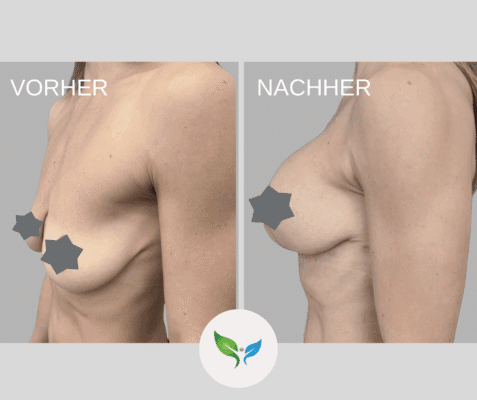 Brustvergrößerung (Augmentation) - vorher und nachher