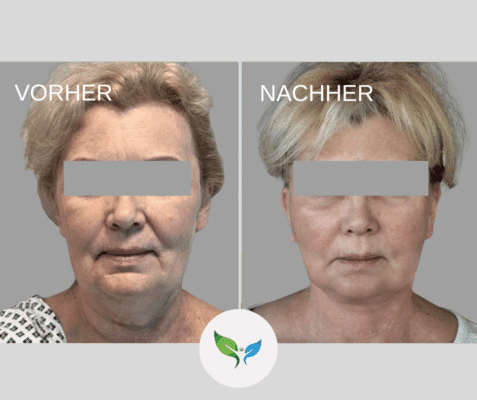 Deep Plane Facelift und Necklift