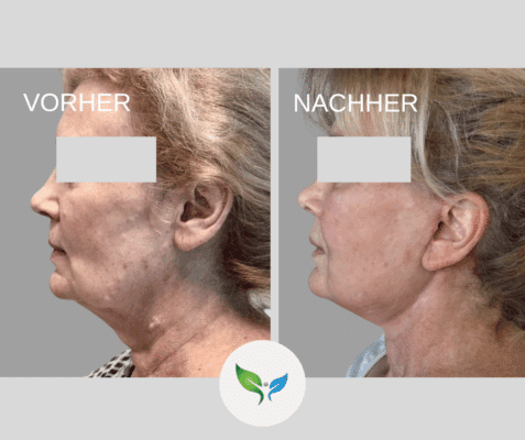 Deep Plane Facelift und Necklift vorher und nachher