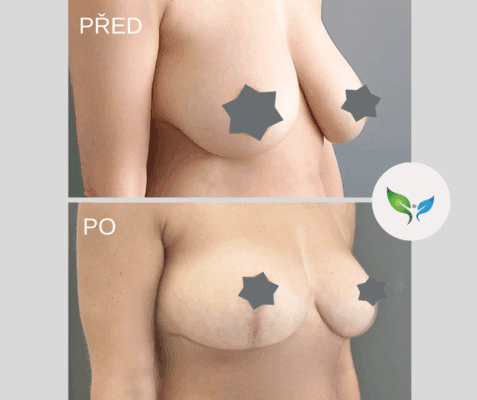Modelace prsou - Mammaplastika, Mastopexie před a po