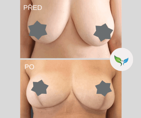 Modelace prsou - mammaplastika - před a po