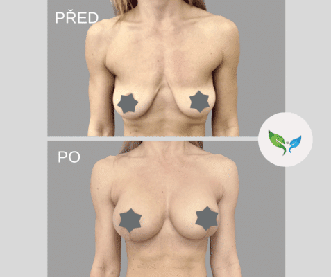 Augmentace prsou implantáty před a po