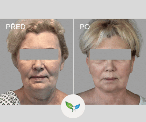 Deep Plane Facelift a necklift před a po