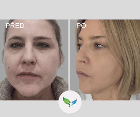 Frakční laser - ošetření obličeje před a po