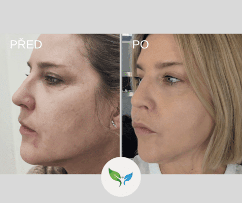 Frakční laser - ošetření obličeje