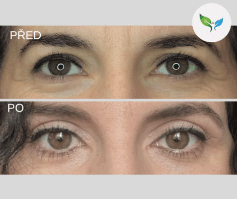 lidstraffung-blefaroplastik