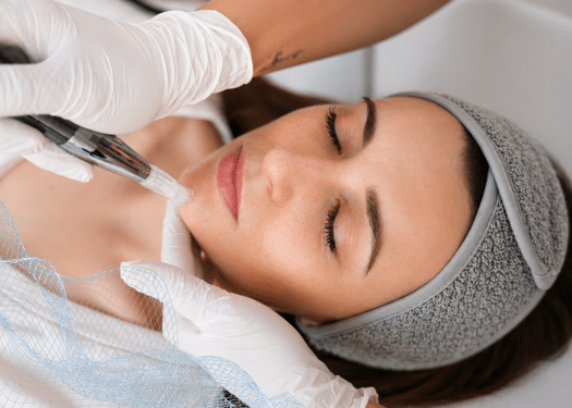 3x Microneedling