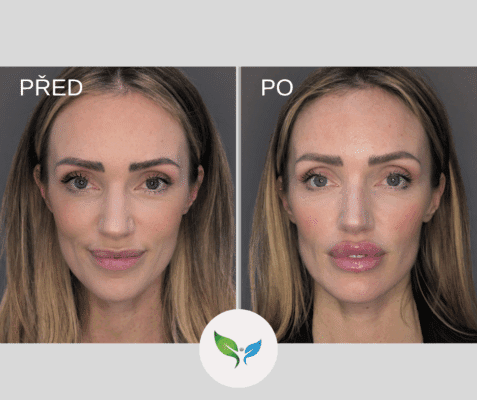 zvětšení rtů (MUDr. Paduchová)