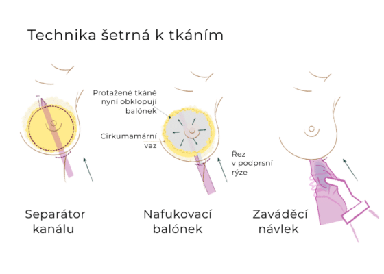 Preservé technika šetrná k tkáním